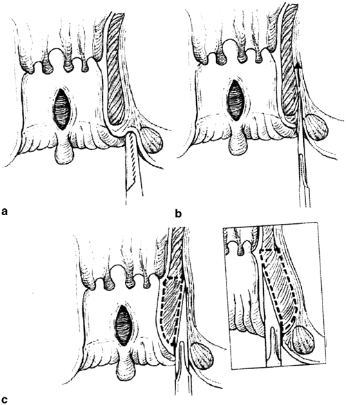 Lateral Anal Sphincterotomy 84