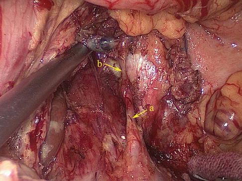 Laparoscopic Cardial Area Lymph Node Dissection for Gastric Cancer