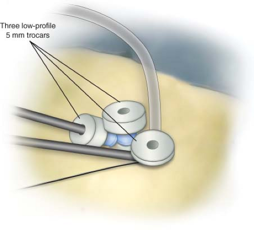 Single Incision Laparoscopic Surgery Total Extraperitoneal Inguinal