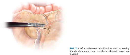 Laparoscopic Transverse Colectomy Abdominal Key 7105