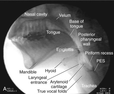 Instrumental Swallowing Examinations: Videofluoroscopy and Endoscopy