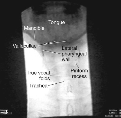 Instrumental Swallowing Examinations: Videofluoroscopy and Endoscopy