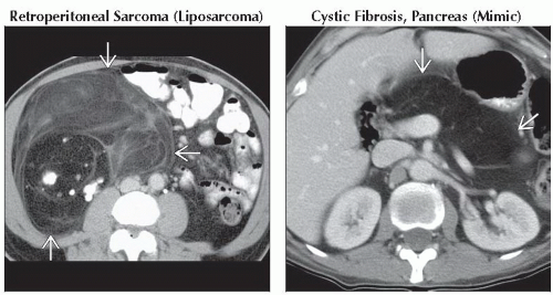 Da Db Fat Containing Lesion Peritoneal Cavity Ffu Abdominal Key