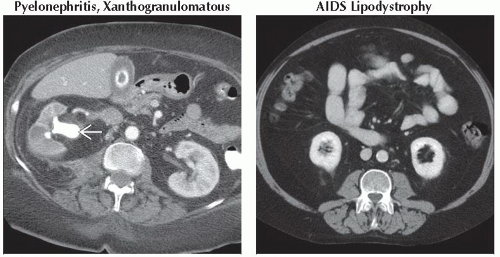 Da Db Retroperitoneal Mass Fat Containing Ffu Abdominal Key