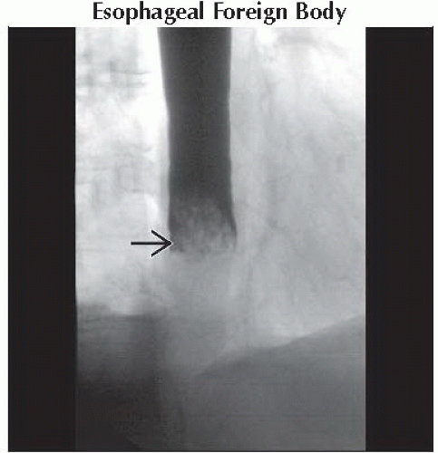 DA3 DB1 Intraluminal Mass Esophagus FFU2 Abdominal Key