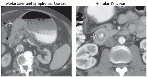 DA4 DB1 Gastric Dilation Or Outlet Obstruction FFU7 Abdominal Key