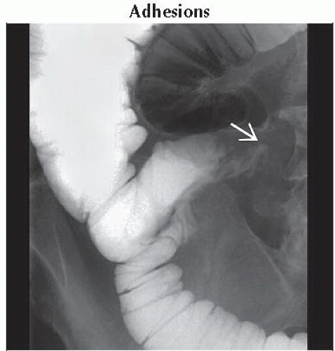 DA6 DB2 Small Bowel Obstruction FFU1 Abdominal Key