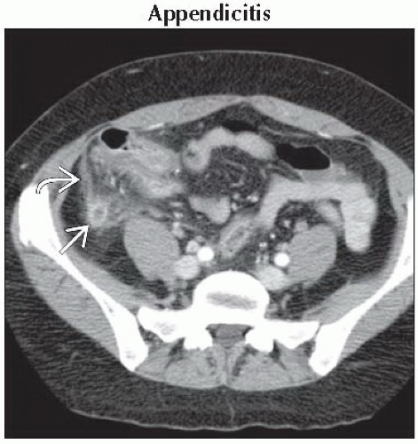 DA7 DB2 Acute Right Lower Quadrant Pain FFU1 Abdominal Key