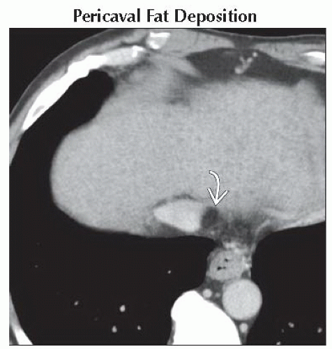 Da Db Fat Containing Liver Mass Ffu Abdominal Key