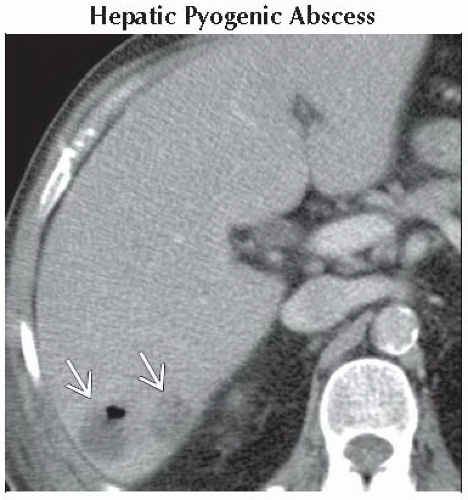 Da Db Liver Lesion Containing Gas Ffu Abdominal Key