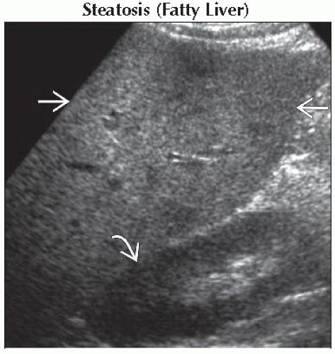 DA9 DB2 Hyperechoic Liver Diffuse FFU2 Abdominal Key