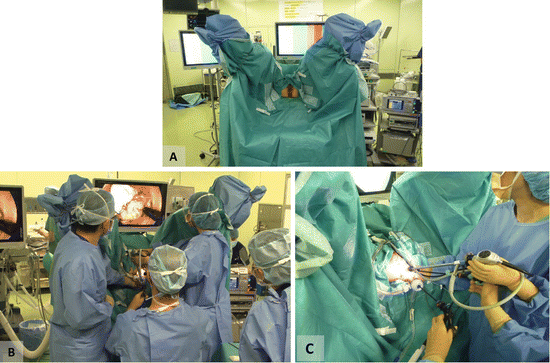 transanal-minimally-invasive-surgery-for-rectal-cancer-abdominal-key