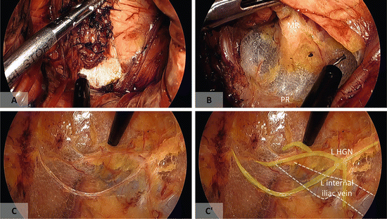 Transanal Minimally Invasive Surgery for Rectal Cancer | Abdominal Key