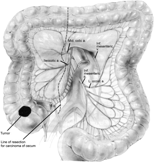 Surgical Therapy For Colorectal Adenocarcinoma Abdominal Key