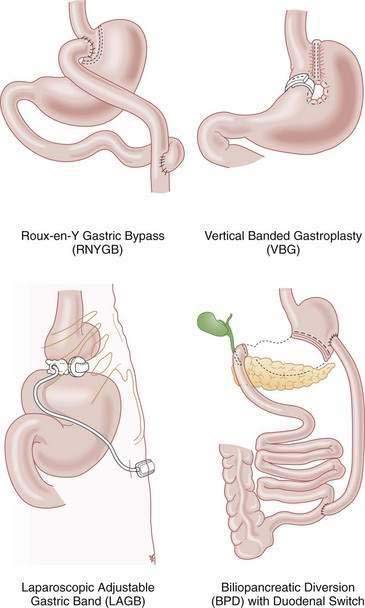 Bariatric Surgery Abdominal Key 0967