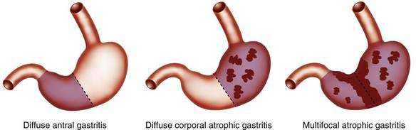 gastritis-and-gastropathies-abdominal-key