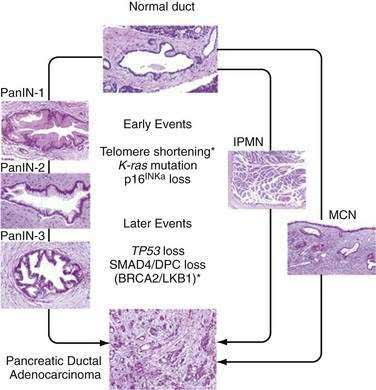 Tumors of the Pancreas | Abdominal Key