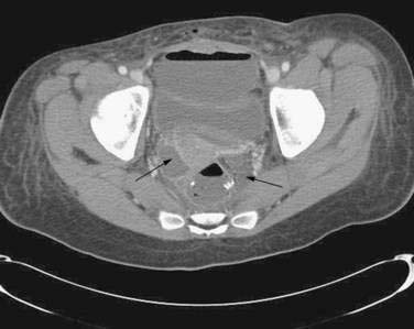 Ileostomy, Colostomy, and Pouches | Abdominal Key