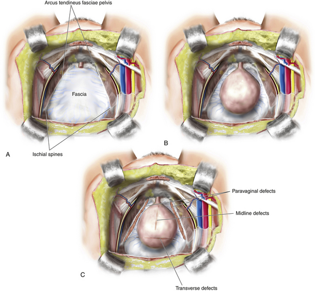 Repair of Anterior Vaginal Prolapse