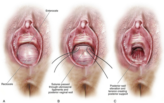 A large posterior vaginal wall cyst simulating rectocele: an account of an  unusual perplexing case - Document - Gale Academic OneFile