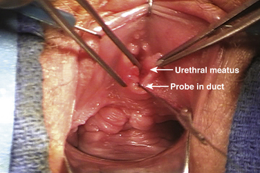 Cureus  A Rare Case of Posterior Vaginal Wall Gartner's Duct Cyst