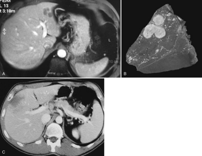 Benign Liver Lesions | Abdominal Key