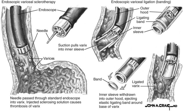 Esophageal Varices Acute Management Of Portal Hypertension Abdominal Key