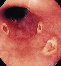 Infections of the Luminal Digestive Tract | Abdominal Key