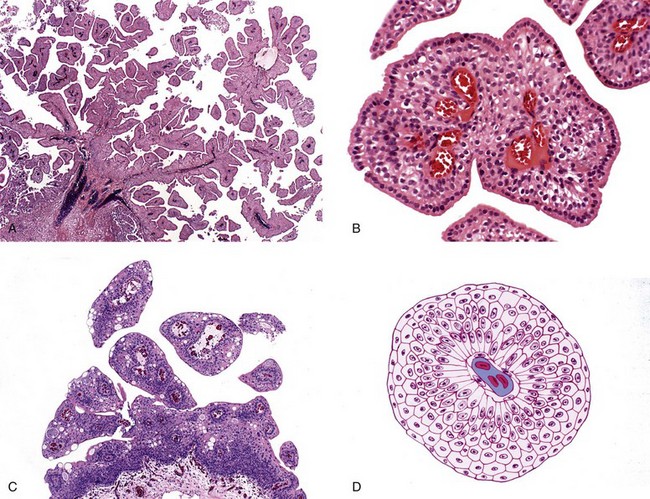papillary lesions of urinary bladder)