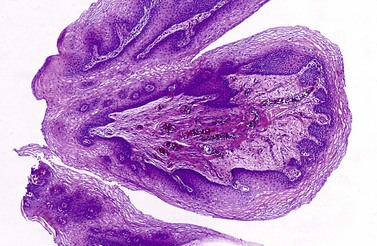 Transitional cell papilloma of the bladder Condilom vulvar