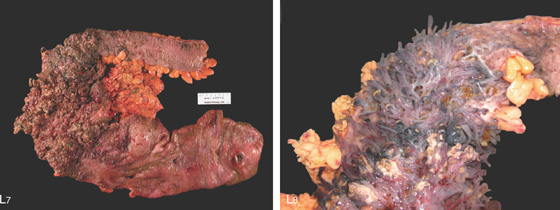 focal narrowing in the splenic flexture of the colon