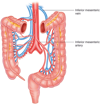 Мезентериальный тромбоз нижней брыжеечной артерии. Мезентериальный тромбоз сосудов. Нижняя брыжеечная артерия и Вена. Мезентериальный тромбоз верхней брыжеечной артерии.. Острый мезентериальный тромбоз