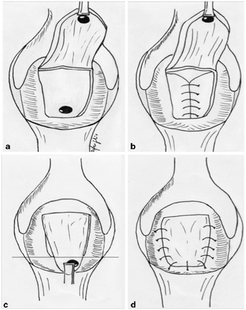 Rectal Advancement Flap Rectovaginal Fistula