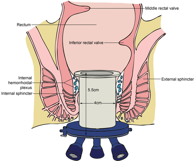 Transanal Minimally Invasive Surgery For Rectal Cancer Abdominal Key 9240