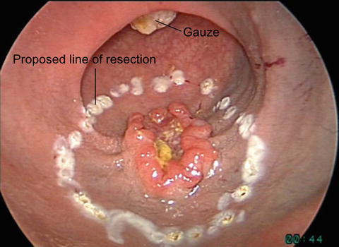 Transanal Minimally Invasive Surgery for Rectal Cancer | Abdominal Key