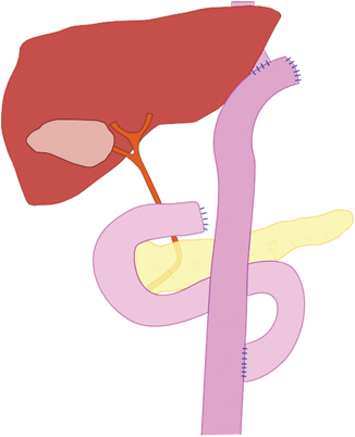 The Historical Perspective of Gastric Cancer | Abdominal Key