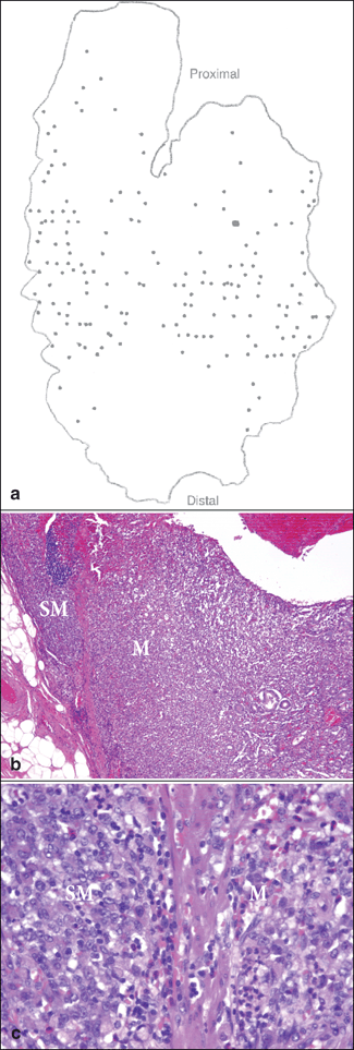 Pathophysiology Of Hereditary Diffuse Gastric Cancer | Abdominal Key