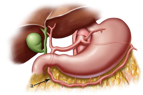 Laparoscopic Infrapyloric Area Lymph Node Dissection for Gastric Cancer ...