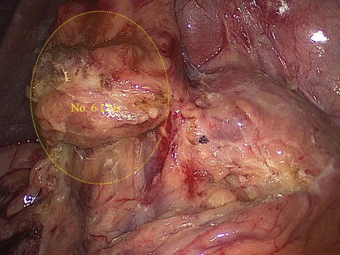 Laparoscopic Infrapyloric Area Lymph Node Dissection for Gastric Cancer
