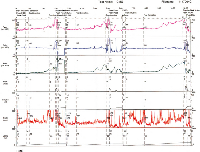 VOIDING DYSFUNCTION AND NEUROLOGIC DISORDERS | Abdominal Key