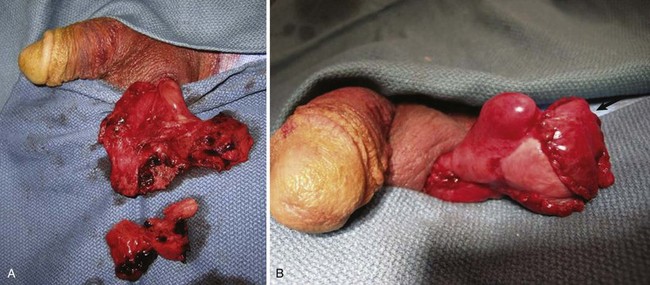 A, Testicular rupture after blunt trauma. 