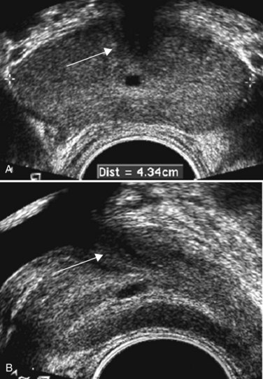 Ultrasonography And Biopsy Of The Prostate Abdominal Key My Xxx Hot Girl 1358