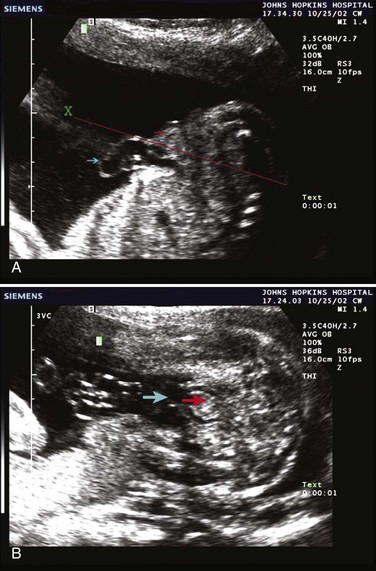 bladder exstrophy ultrasound