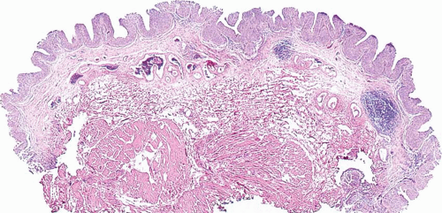 papilláris urothelialis neoplazma kiújulása gyertya a nemi szemölcsökhöz