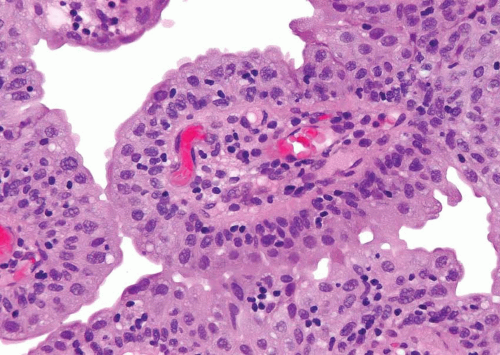 Papilláris urothelialis neoplazma alacsony malignus potenciállal rendelkezik A vizelet üledéke