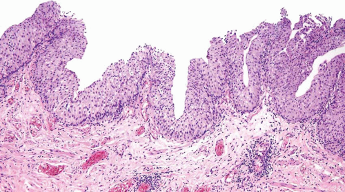 papillary urothelial hyperplasia
