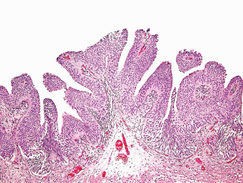 Papilláris urothelialis neoplazma icd 10. Fotók a vese rákról - Készítmények - October