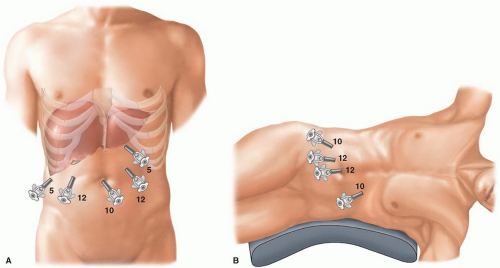 Laparoscopic Partial Hepatectomy