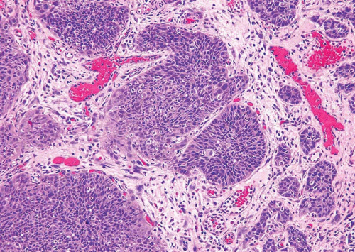 invasive-urothelial-carcinoma-abdominal-key