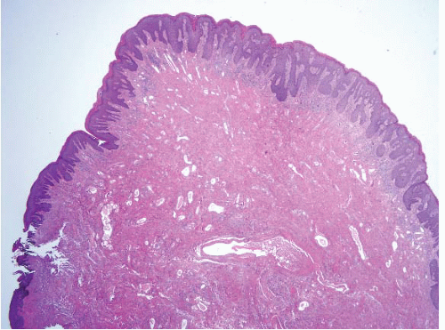 fibroepithelial polyp histology